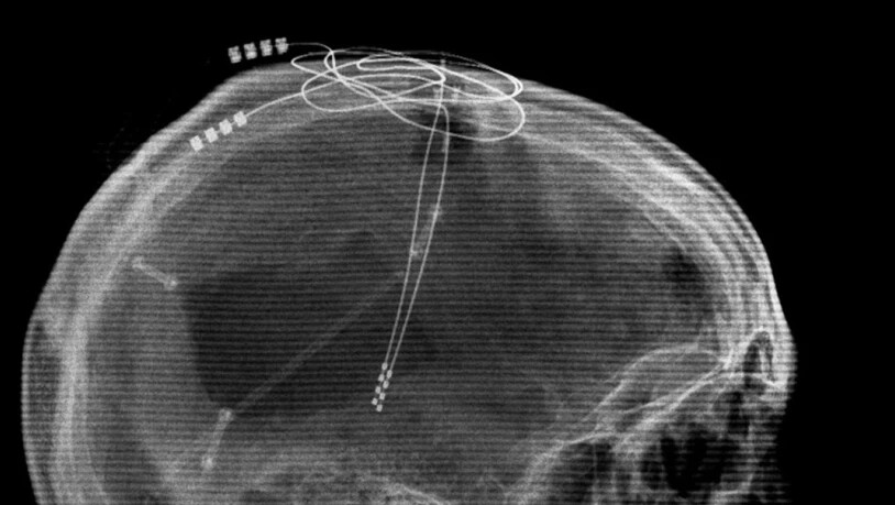 Röntgenbild eines Patienten mit implantierten Elektroden zur Tiefen Hirnstimulation (Deep Brain Stimulation DBS), einer Therapieform zur Linderung von Parkinson. Der Welt-Parkinson-Tag vom kommenden Sonntag erinnert daran, dass es jede/n treffen kann und…