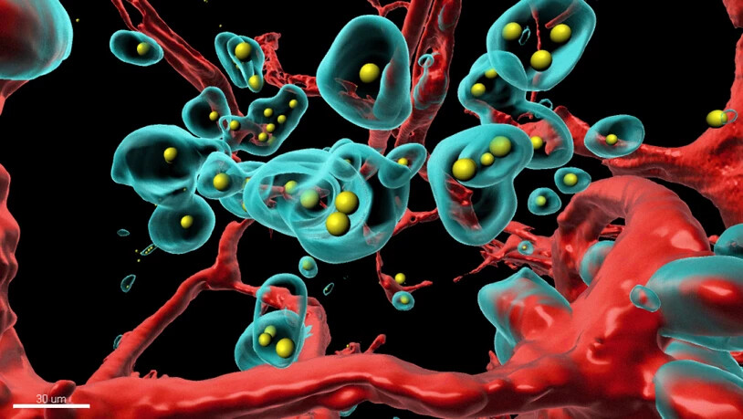 Zürcher Forschenden gelang es mit einer neuartigen Technologie, dass Tumorzellen (türkis) gegen sich selbst gerichtete Antikörper (gelb) in ihrem Inneren produzierten. (Pressebild)