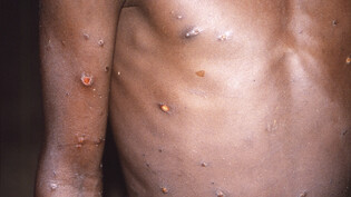 Typische Krankheitsmerkmale beim Befall durch Affenpocken. (Archivbild aus Zentralafrika)